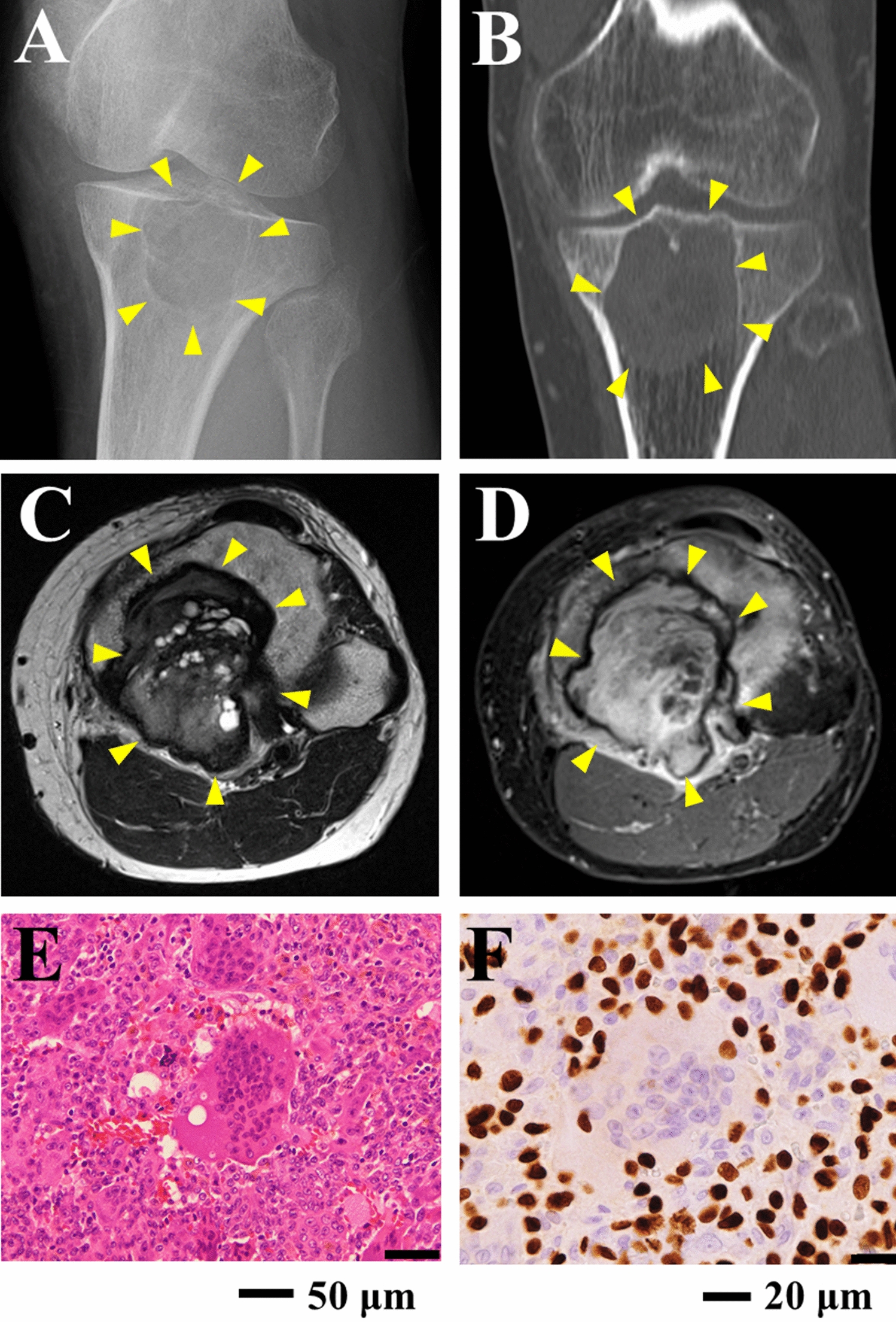 Establishment and characterization of two novel patient-derived cell lines from giant cell tumor of bone: NCC-GCTB8-C1 and NCC-GCTB9-C1
