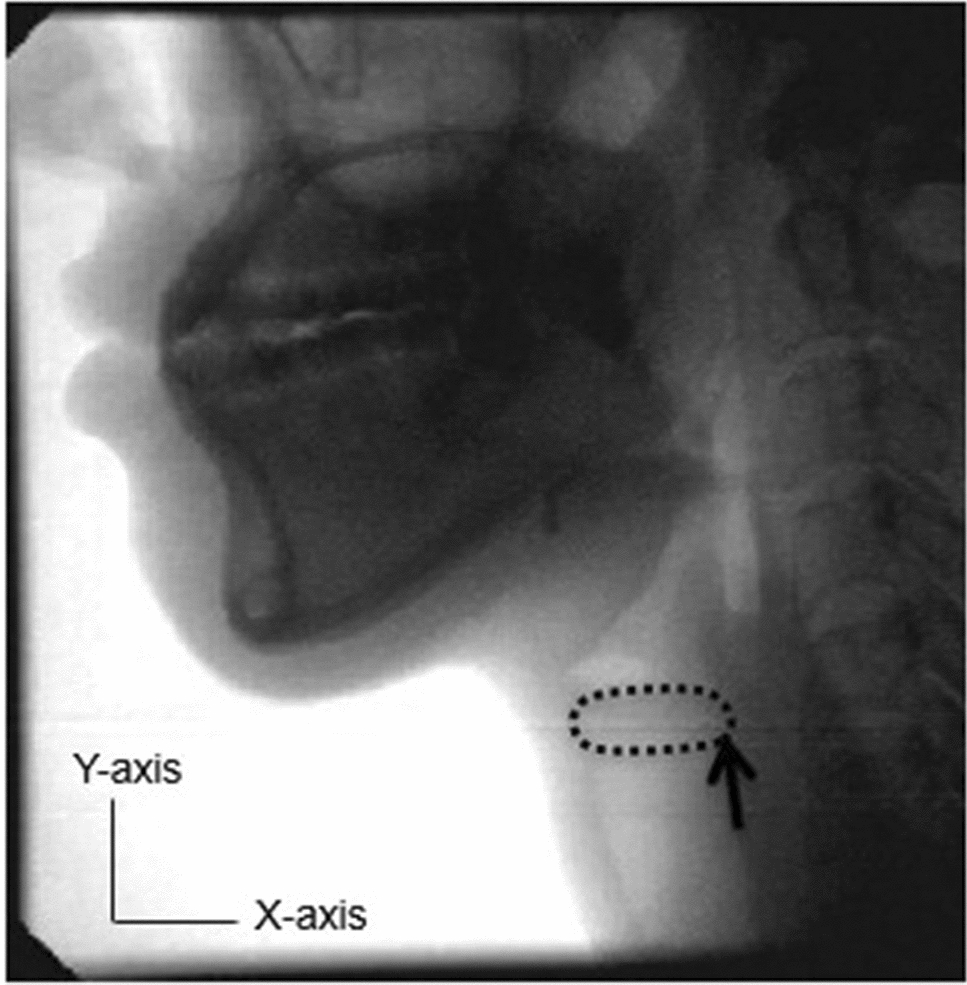 Videofluoroscopic analysis of the laryngeal movement of older adults in swallowing