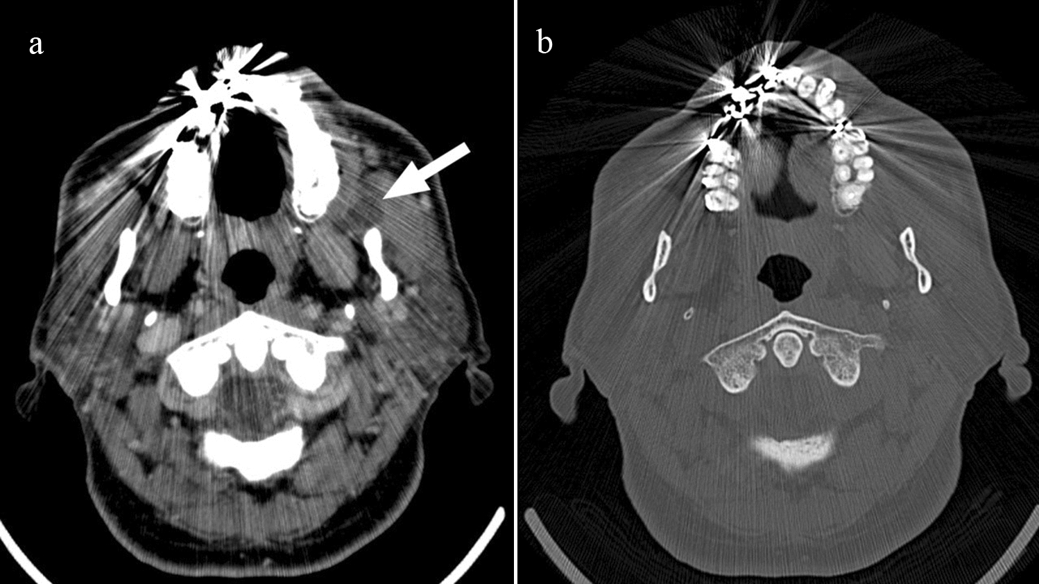 A case of odontogenic keratocyst in the buccal space: characterization by multimodality imaging including computed tomography, diffusion-weighted magnetic resonance imaging, and ultrasonography