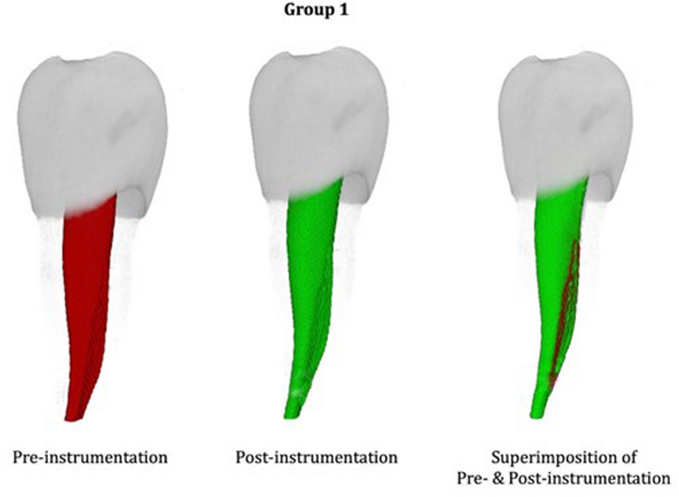 Comparative evaluation of volumetric changes following rotary and hand files’ canal preparation of primary maxillary canine: an in vitro nano-CT analysis