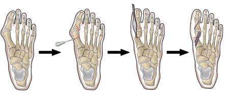 Clinical guideline on the third generation minimally invasive surgery for hallux valgus