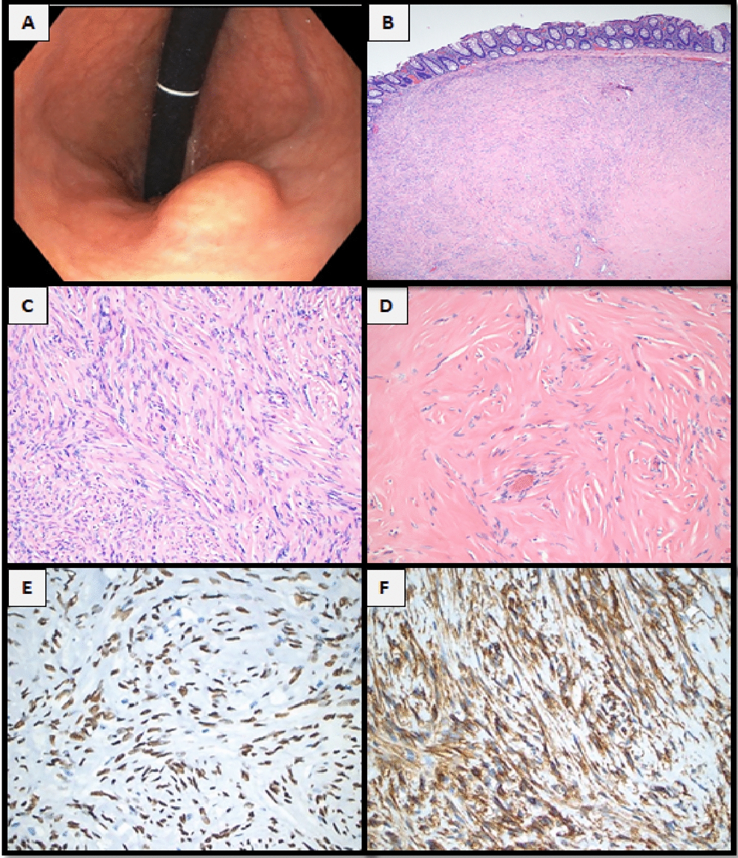 Solitary fibrous tumor occurring in the colon as submucosal mesenchymal lesion: report of two cases and review of the literature