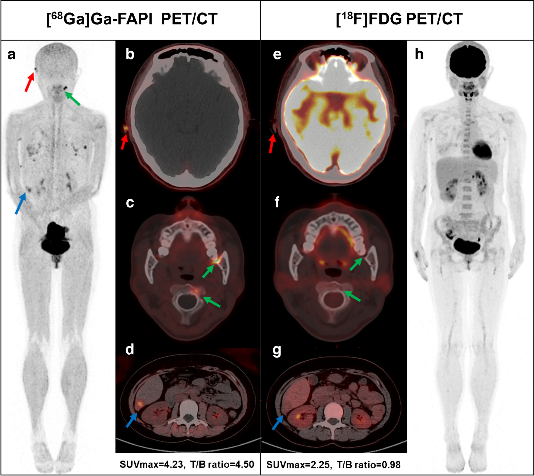 [68Ga]Ga-FAPI versus [18F]FDG PET/CT in the evaluation of Langerhans cell histiocytosis