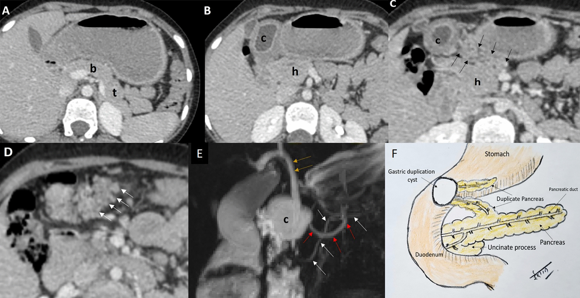 A Rare Cause of Acute Recurrent Pancreatitis in a Child