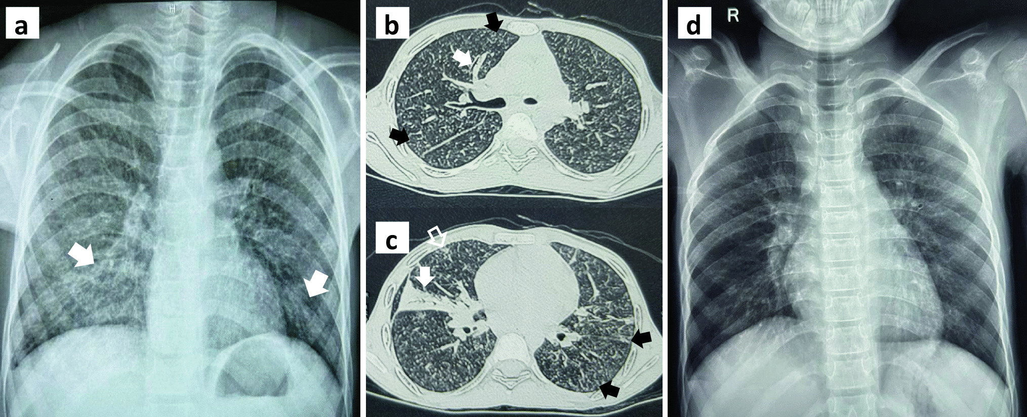 Cough, Eosinophilia and Lung Nodules in a Family – Infection, Infestation or Inheritance?