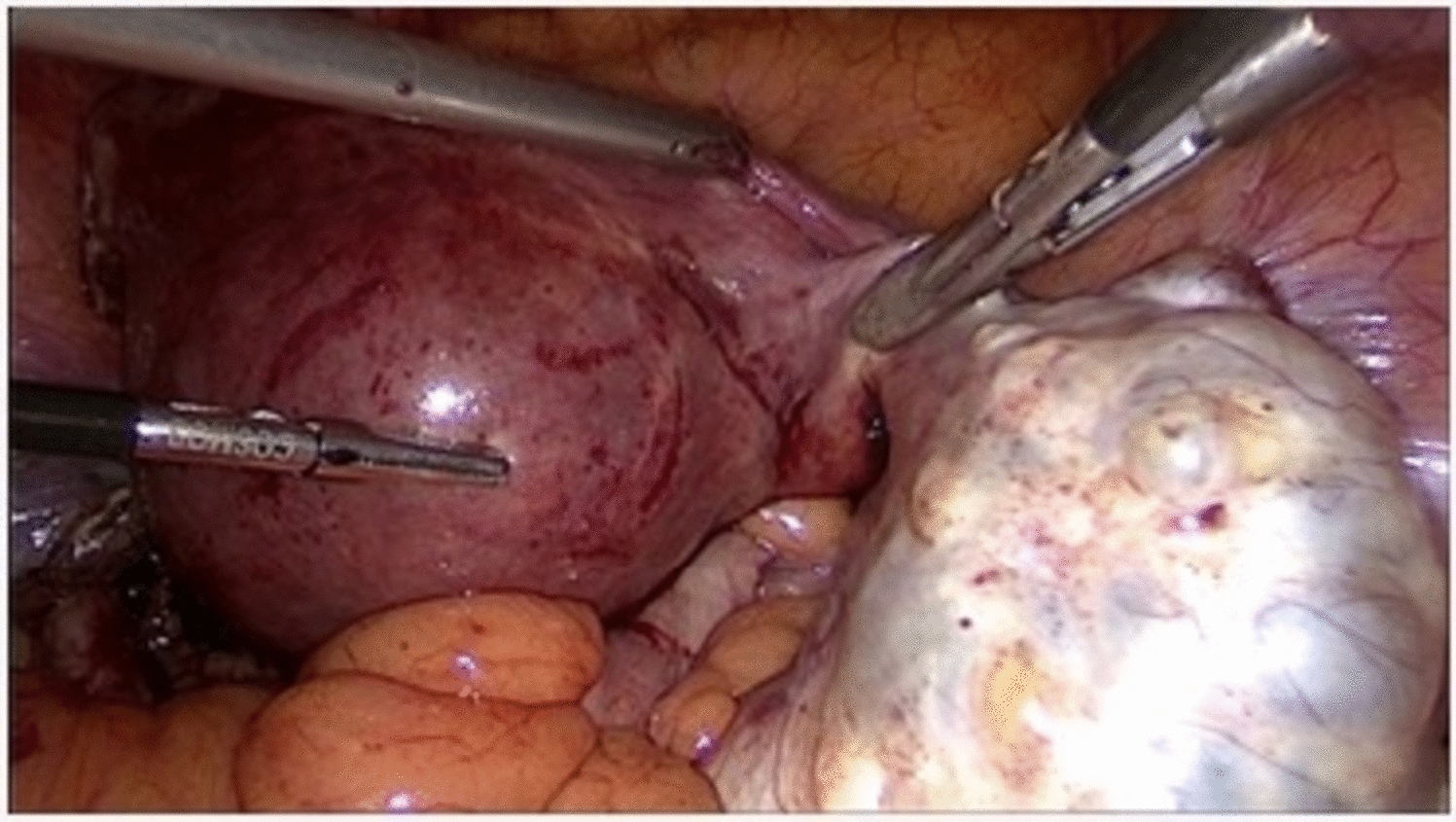 Serous Papillary Cystadenofibroma of Ovary: A Rare Case Report