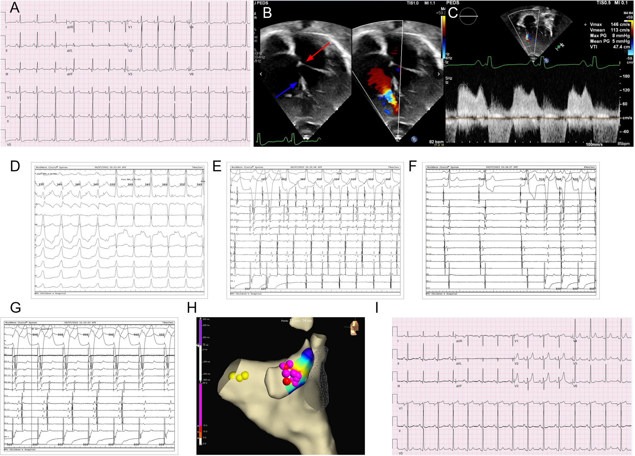 A rare presentation of Ebstein’s anomaly: left-sided accessory pathway and tricuspid stenosis