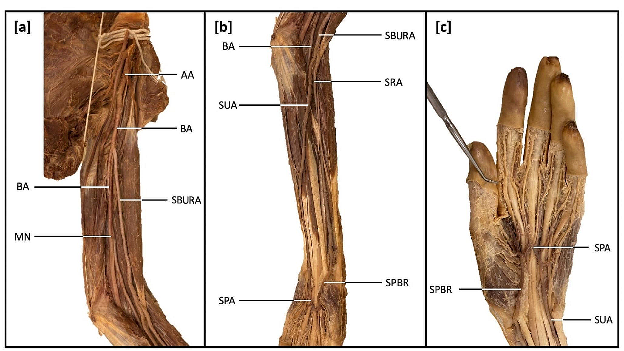 Unilateral identification of a rare superficial brachioulnoradial artery contributing to the superficial palmar arch and brachial artery continuing as the interosseous artery: a case report