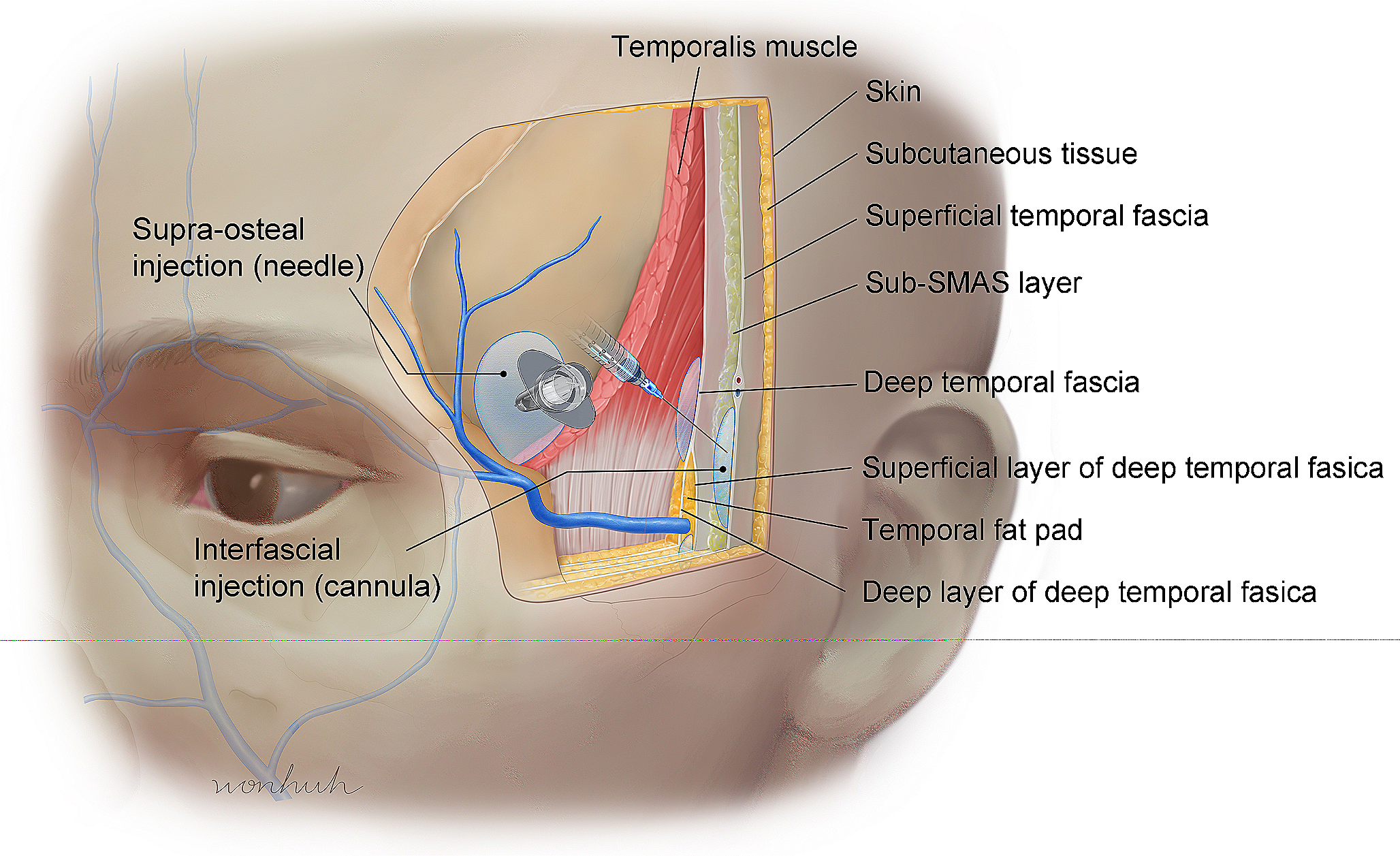 Anatomy of the temporal region to guide filler injections