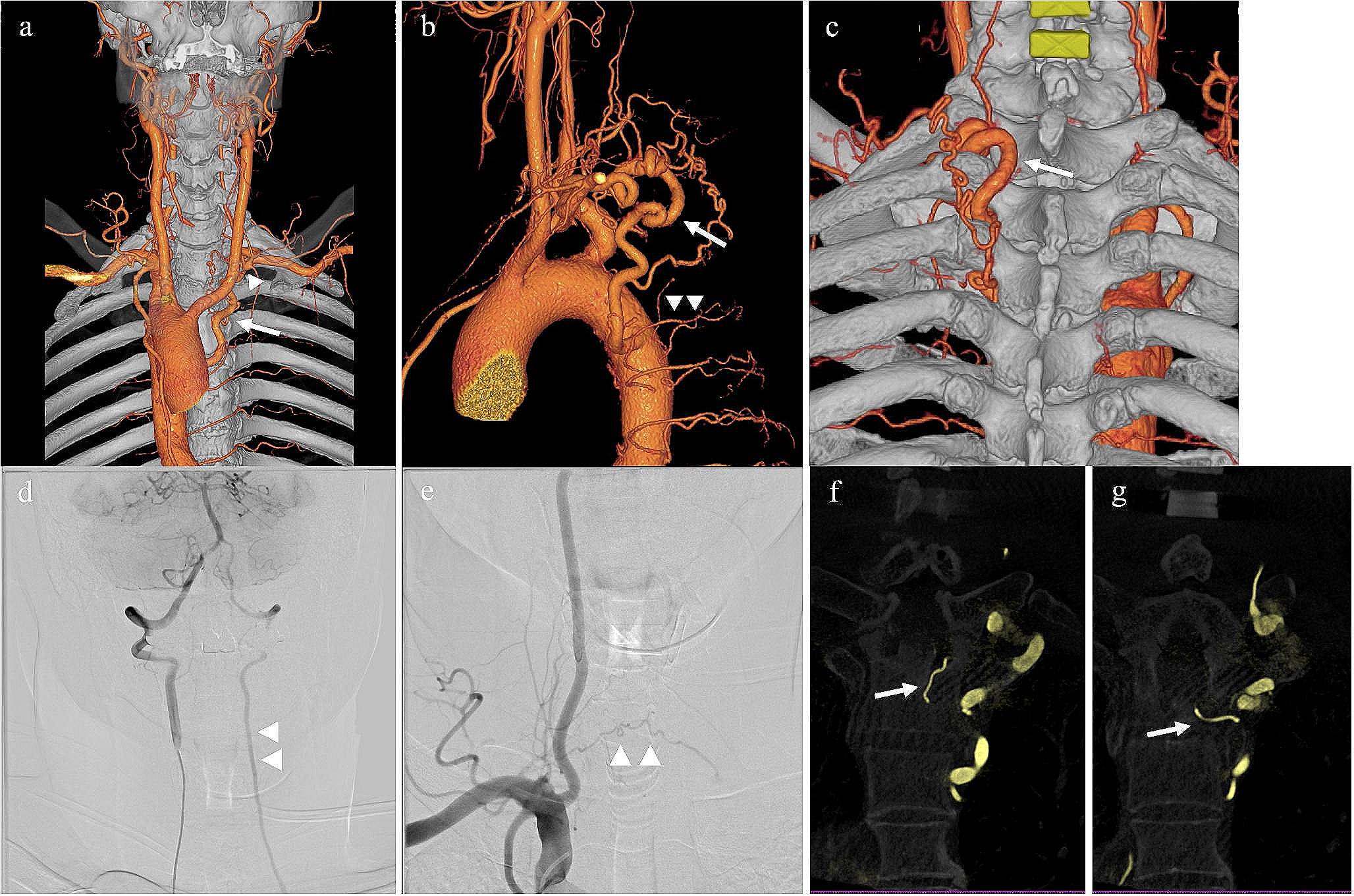 Dysplastic aberrant left subclavian artery originating from a thoracic intersegmental artery associated with a right aortic arch