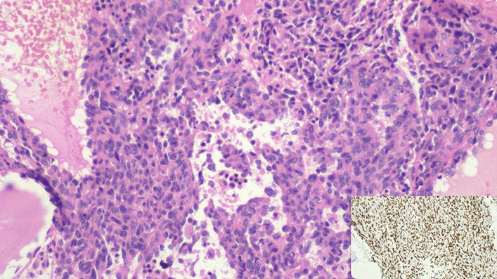 Microangiopathic Haemolytic Anaemia in Metastatic Angiosarcoma: A Grave Marker of Bone Marrow Infiltration