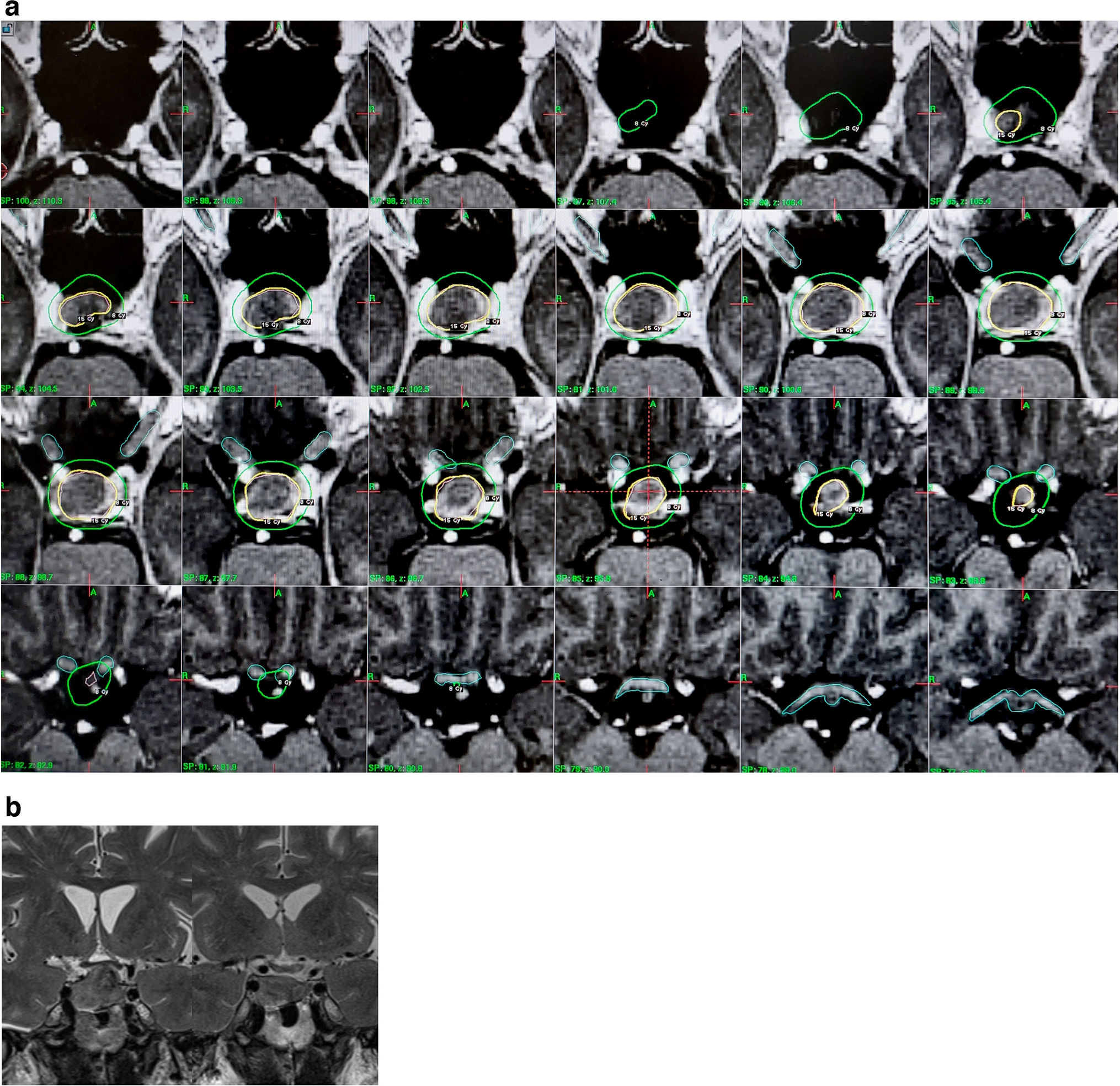 Investigation of the effects of Gamma Knife radiosurgery on optic pathways using diffusion tensor MRI within the first year after treatment