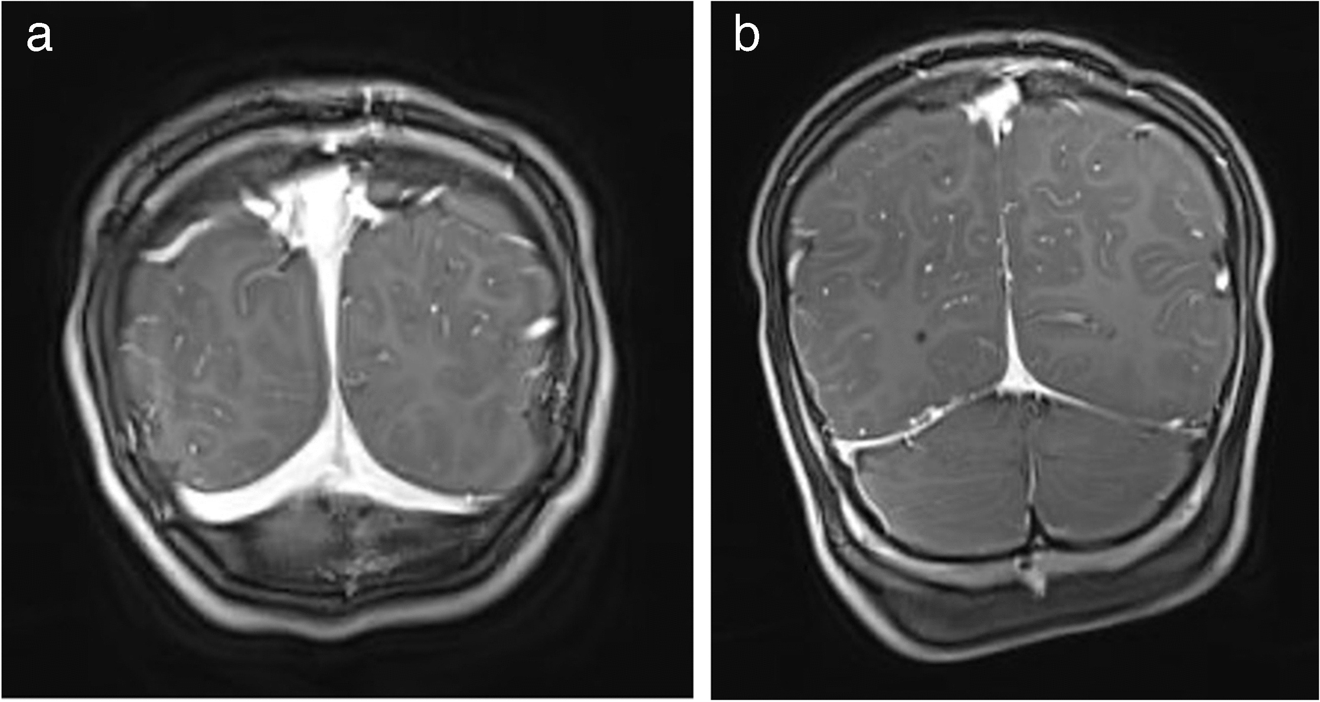 Occipital emissary vein existence and its impact on the diagnosis of idiopathic intracranial hypertension in pediatric patients
