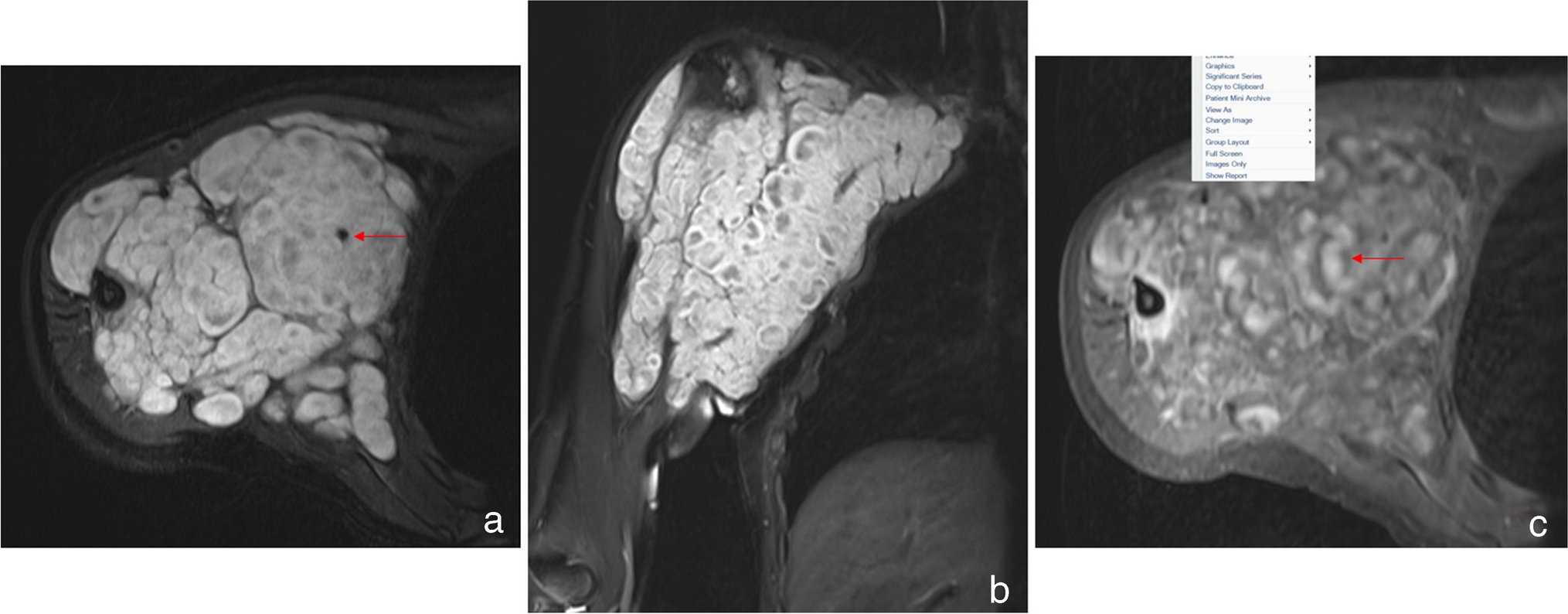 A Rare Presentation of Recurrent Malignant Peripheral Nerve Sheath Tumor with Glandular Differentiation—A Case Report