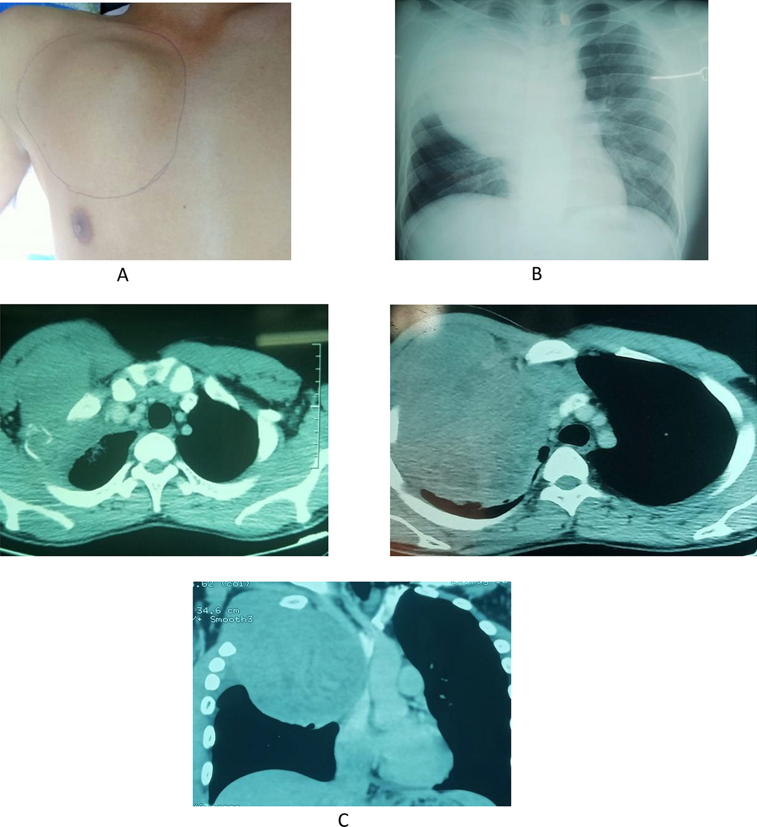 Askin’s Tumor in the Chest Wall—a Rare Clinical Entity and Review of Literature