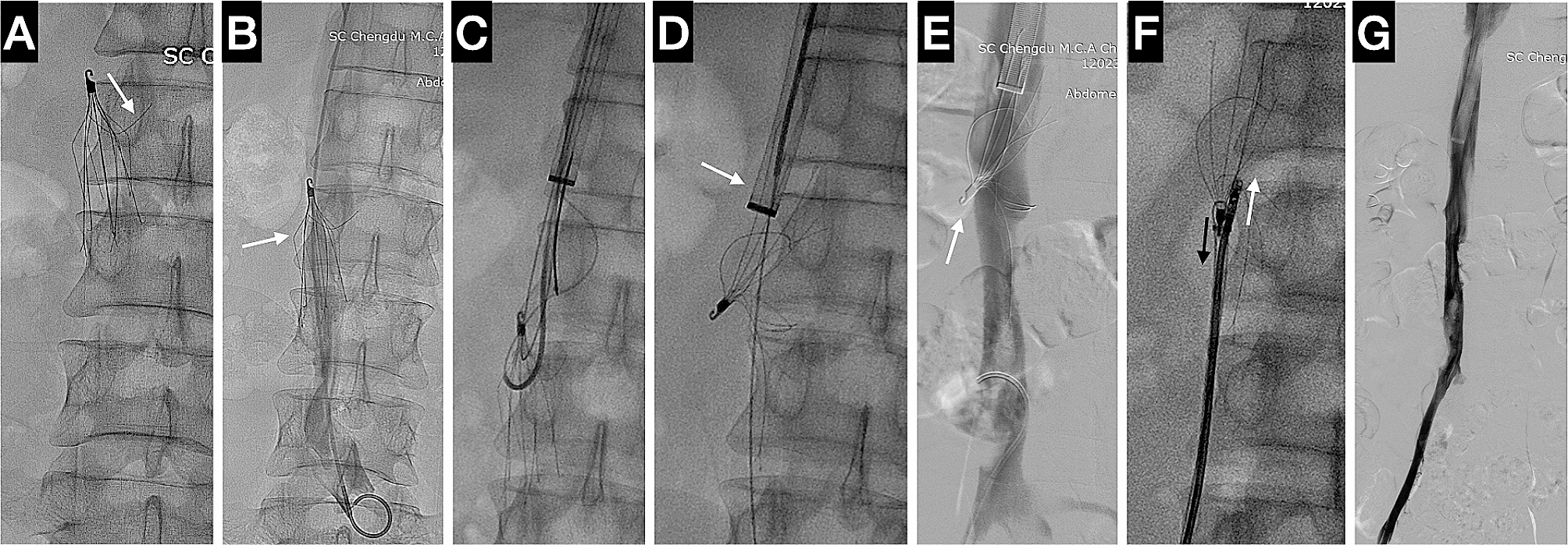 Successful retrieval of tip-embedded inferior vena cava filter using a modified forceps technique: case report