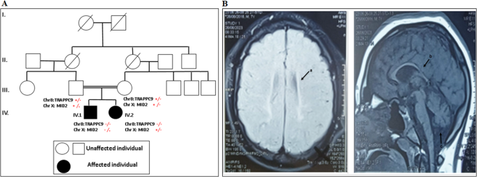 Expanding the genetic and phenotypic spectrum of TRAPPC9 and MID2-related neurodevelopmental disabilities: report of two novel mutations, 3D-modelling, and molecular docking studies