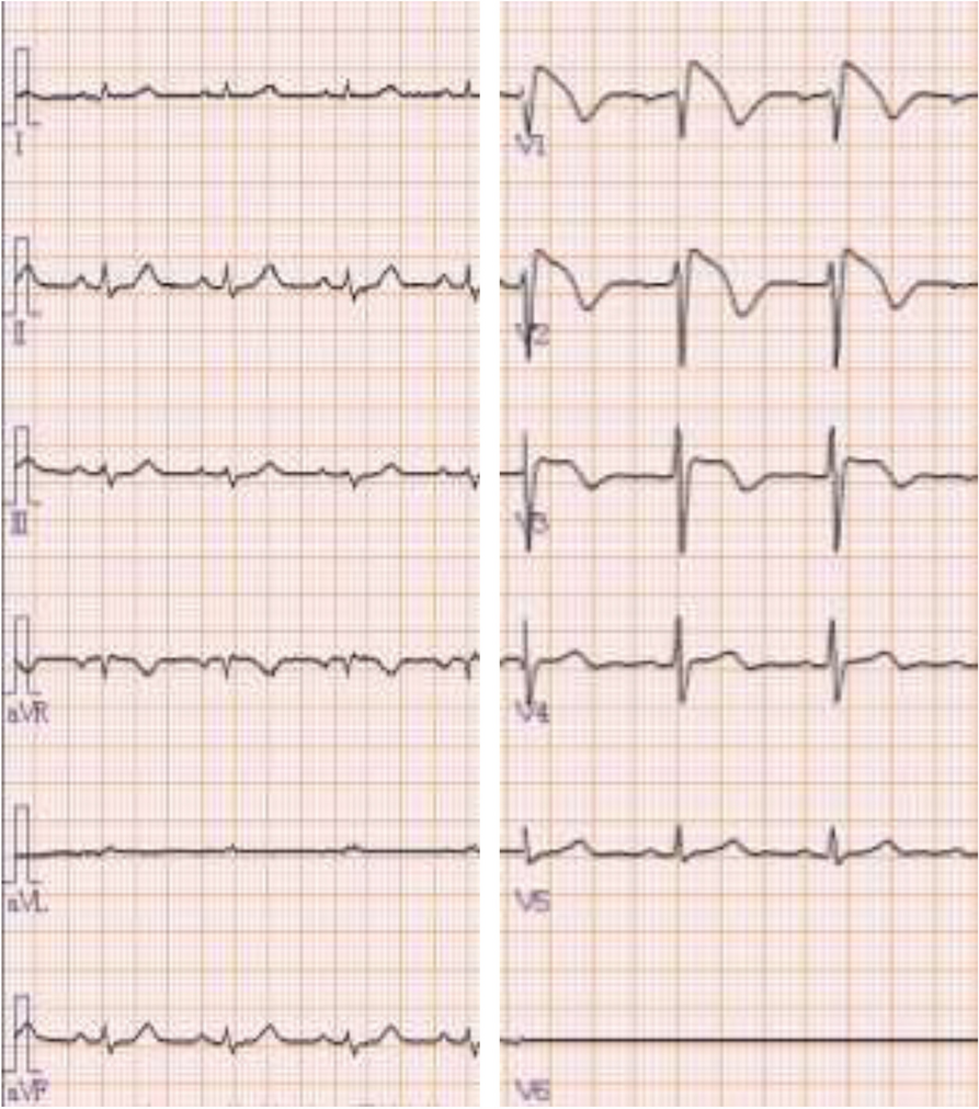 Sustained mitigation of ST-segment elevation in a patient with Brugada syndrome type 1 during sevoflurane and remifentanil anesthesia: a case report