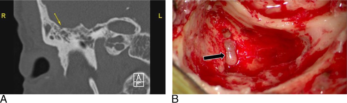 Challenges in the Management of Symptomatic Fallopian Canal Meningoceles: A Multicenter Case Series and Literature Review