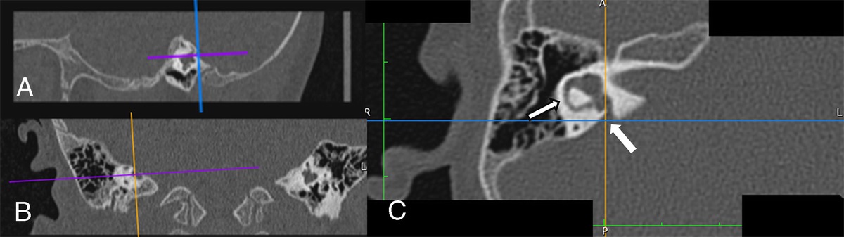 A New Methodology for Evaluation of Large Vestibular Aqueduct in CT and MRI Images
