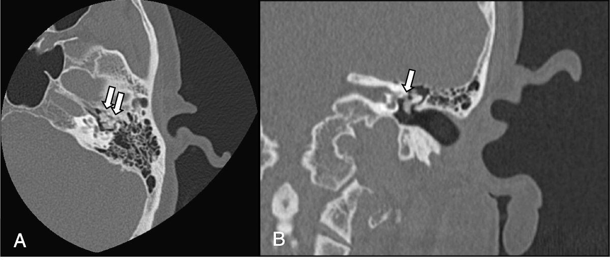 Middle Ear Tophi: A Case Series of Two Unusual Lesions and a Report of Facial Weakness and Review of the Literature