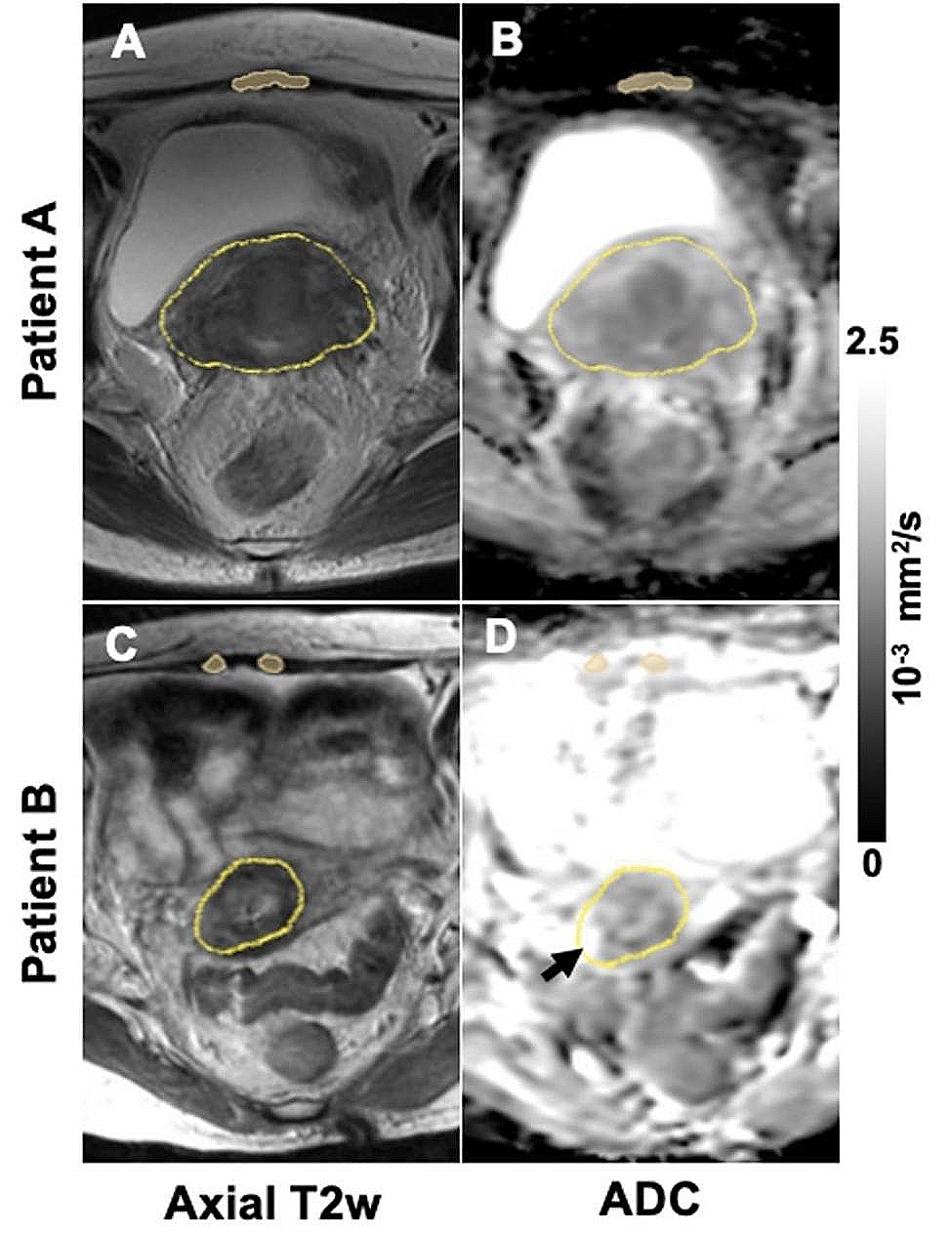 Apparent diffusion coefficient values predict response to brachytherapy in bulky cervical cancer