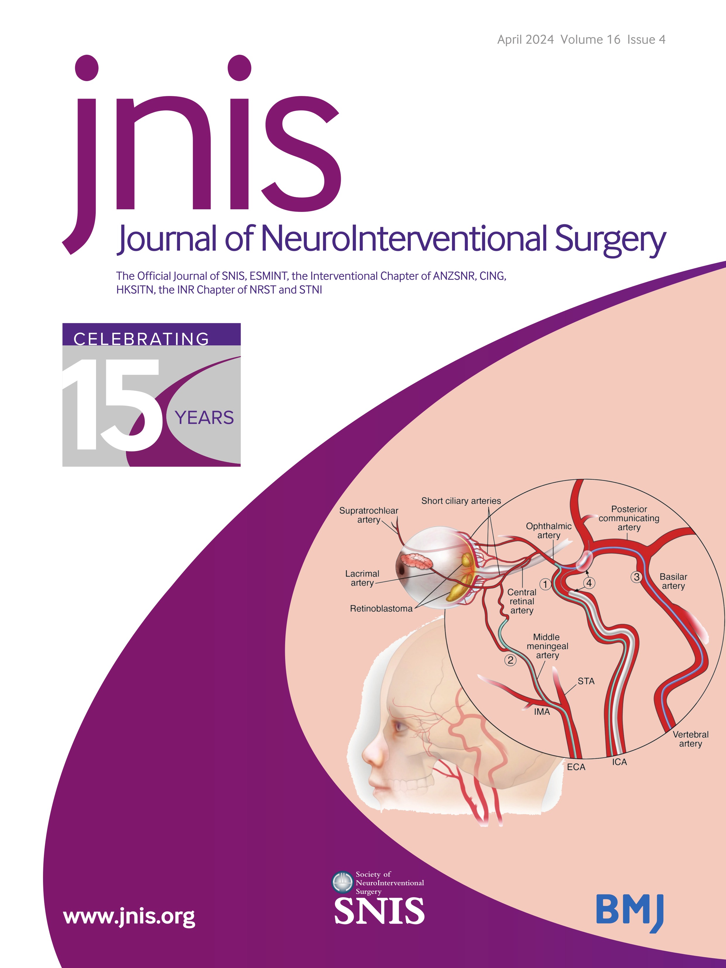 Advancements in super-selective catheterization and drug selection for intra-arterial chemotherapy for retinoblastoma: a 15-year evolution