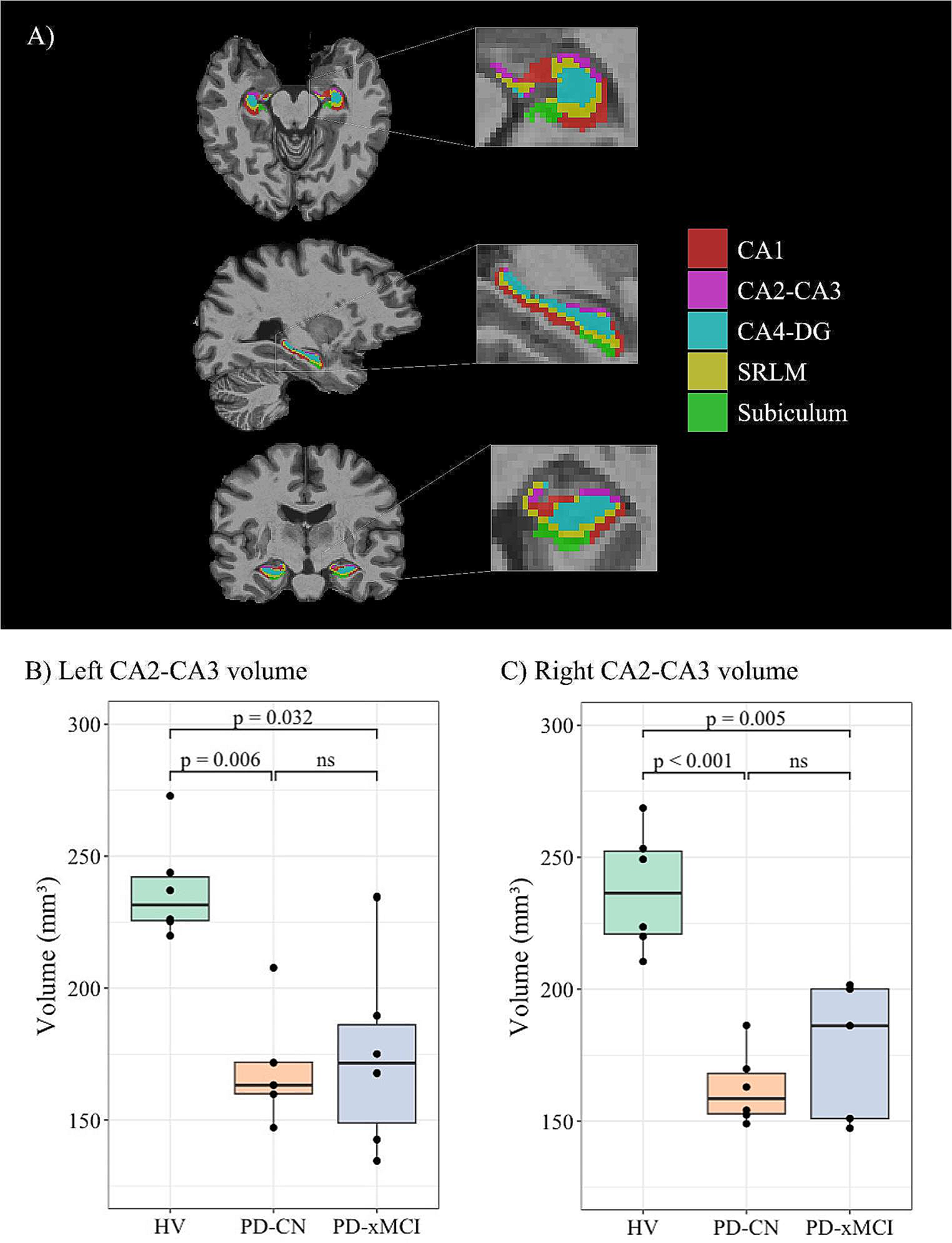 Parkinson’s disease CA2-CA3 hippocampal atrophy is accompanied by increased cholinergic innervation in patients with normal cognition but not in patients with mild cognitive impairment