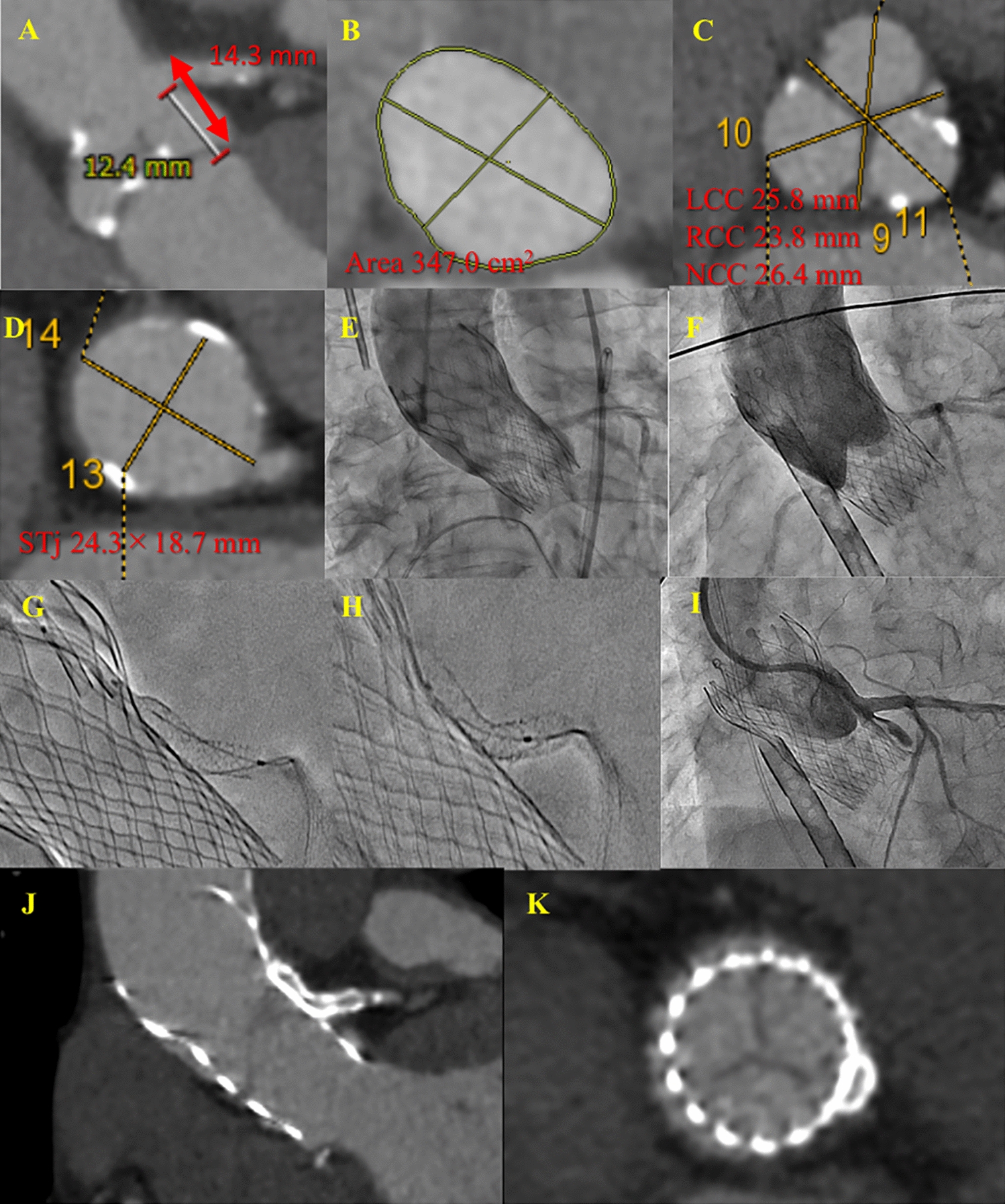 Bailout stenting for delayed coronary obstruction after self-expandable transcatheter aortic valve implantation