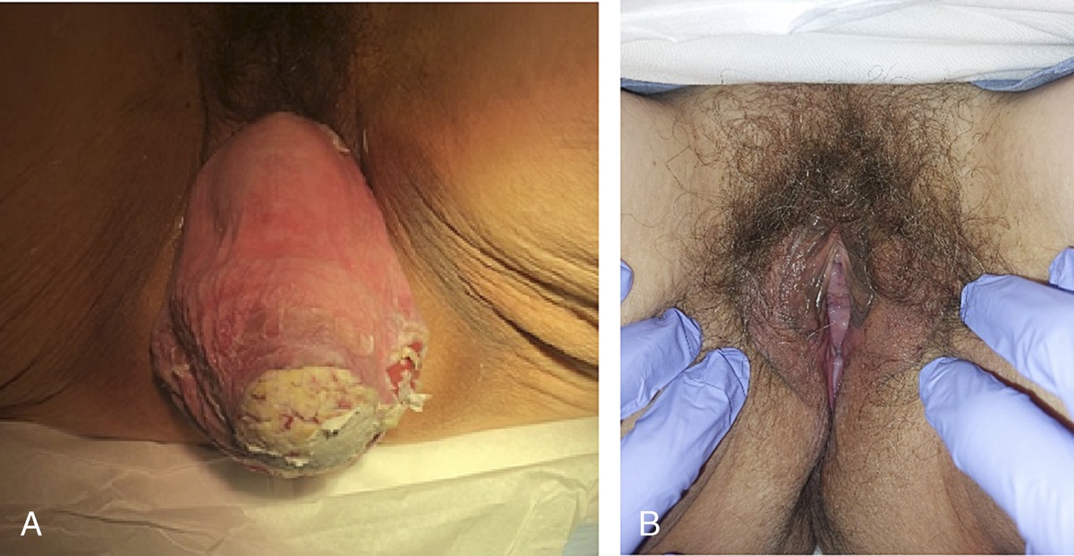 Treatment of Cervical Cancer Complicated by Advanced Pelvic Organ Prolapse: A Case Report