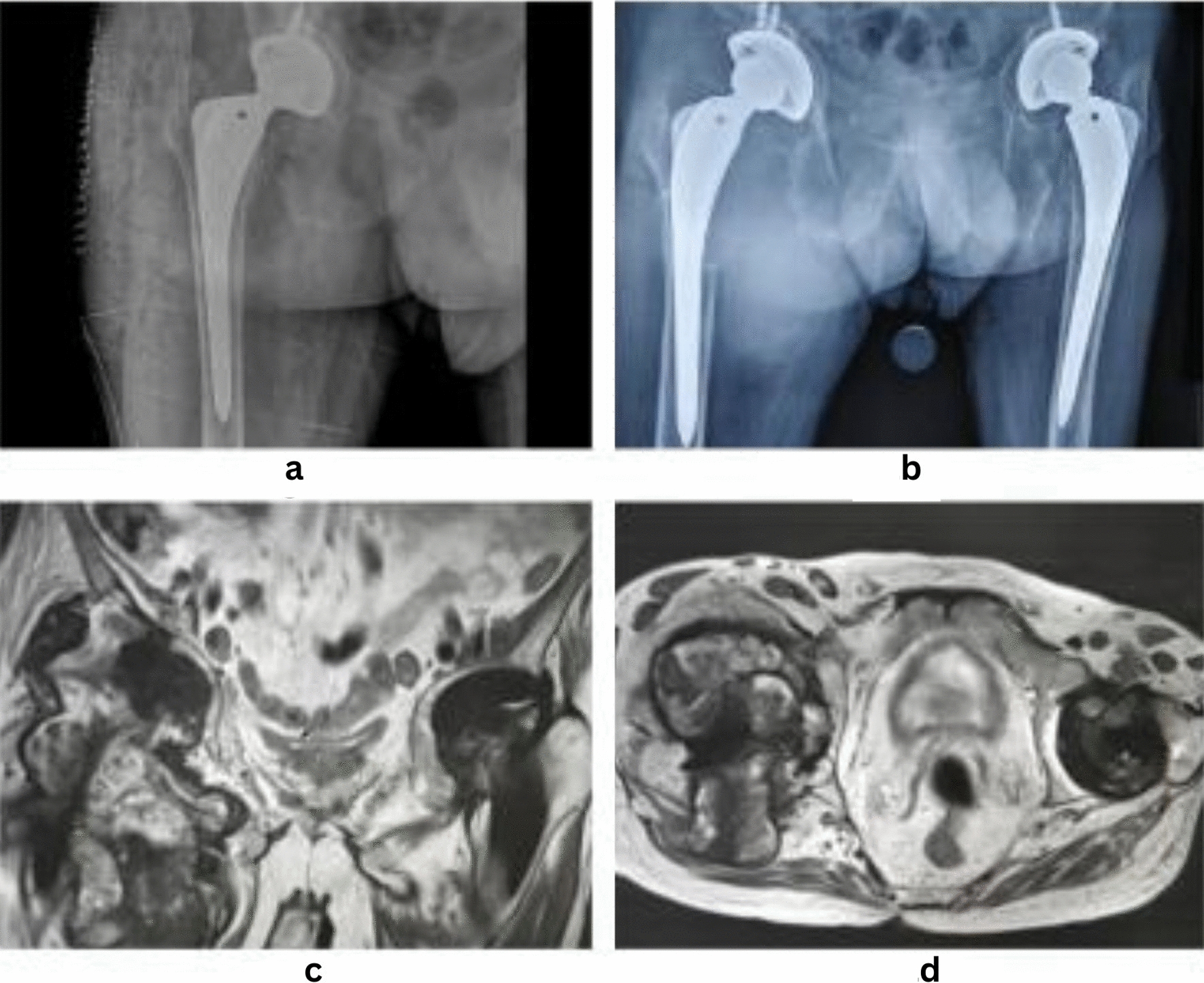 Giant Pseudotumour Following Ceramic on Polyethylene Total Hip Replacement
