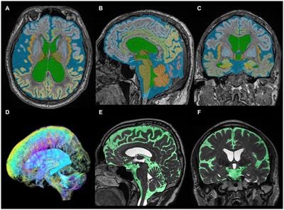 Automatic assessment of disproportionately enlarged subarachnoid-space hydrocephalus from 3D MRI using two deep learning models