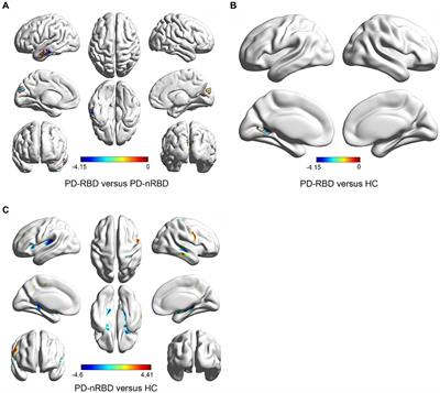 MRI brain structural and functional networks changes in Parkinson disease with REM sleep behavior disorders