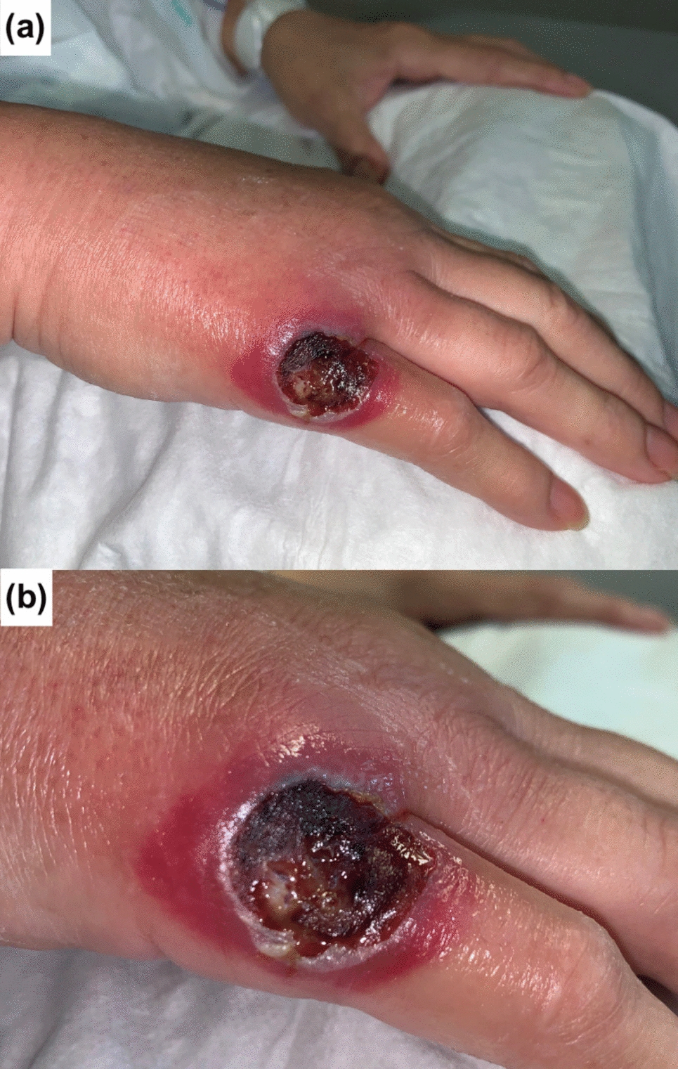‘Lesion on the back of the hand in a hematopoietic stem cell transplant recipient’