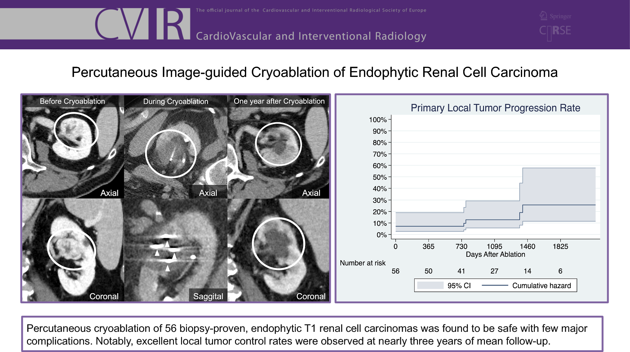 Percutaneous Image-Guided Cryoablation of Endophytic Renal Cell Carcinoma
