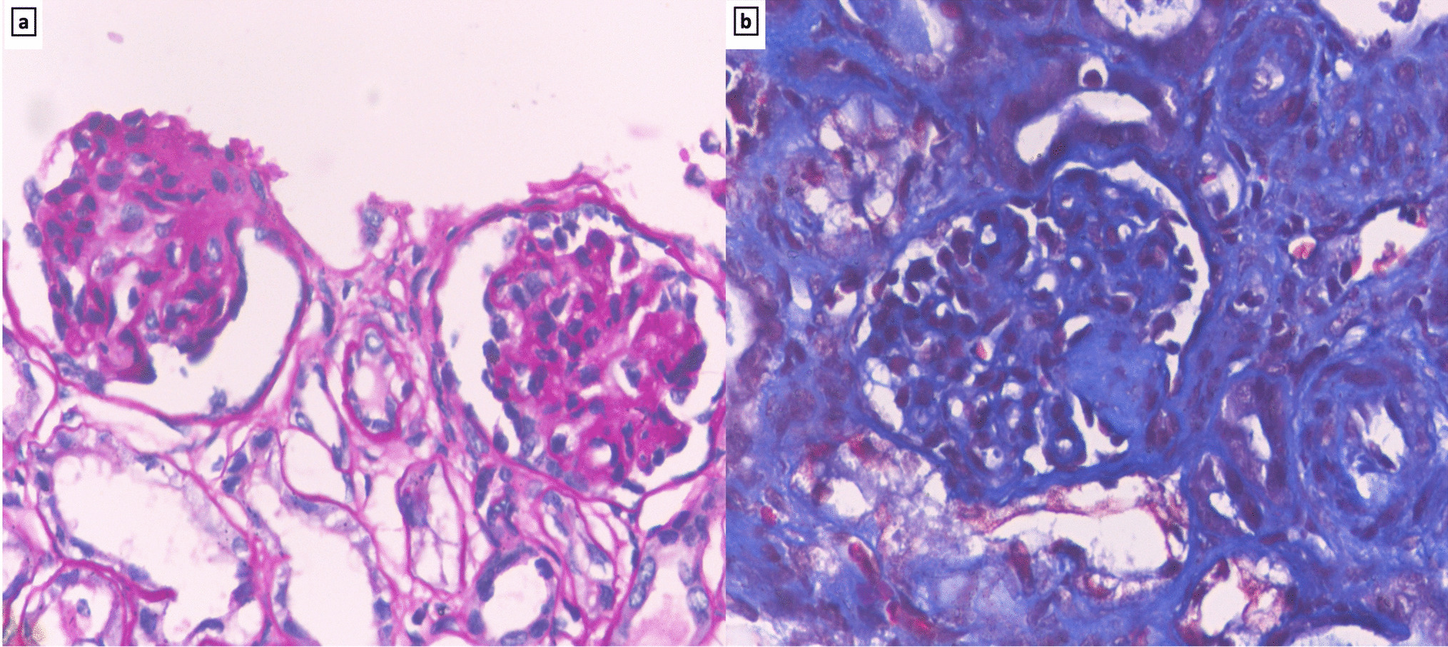 Congenital nephrotic syndrome with diffuse mesangial sclerosis caused by compound heterozygous mutation in LAMA5 gene