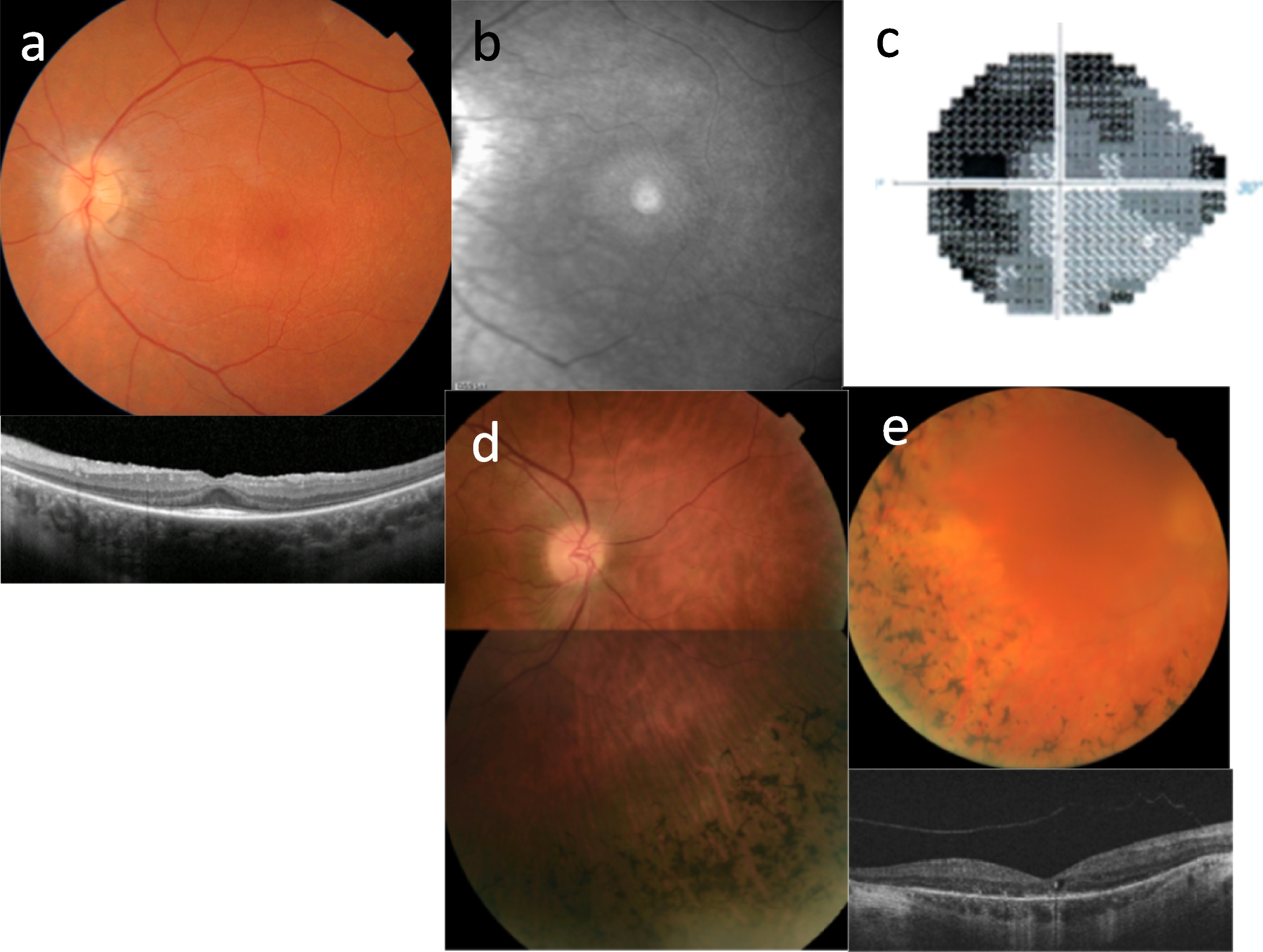 Ocular manifestations of renal ciliopathies
