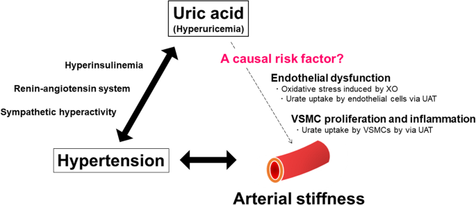 Is uric acid a causal risk factor of arterial stiffness in patients with hypertension?