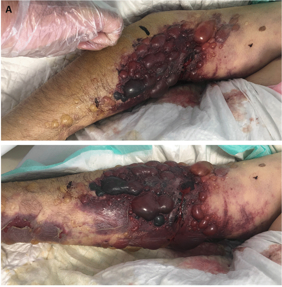 Hemorrhagic bullae and necrotic ulcerations associated with Alteplase extravasation