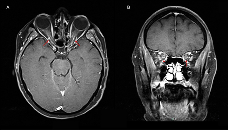 Blurred lines: bilateral optic perineuritis mimicking idiopathic intracranial hypertension