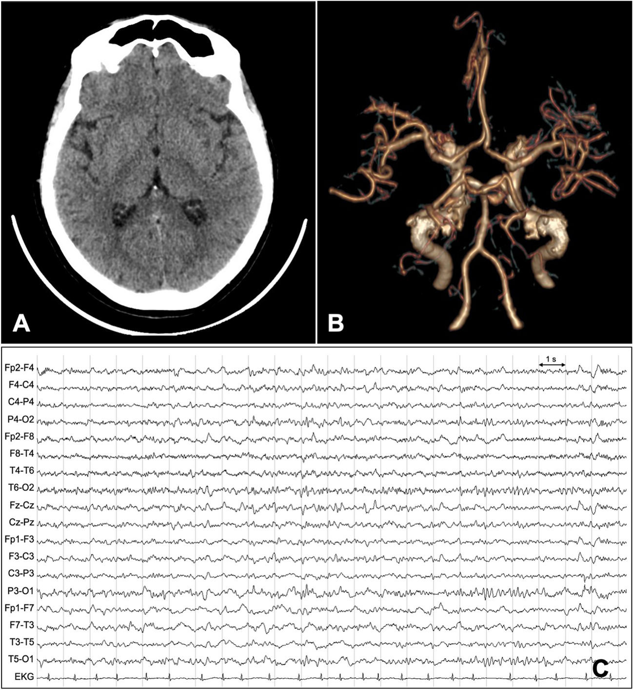 Transient side-changing hemispheric dysfunction: an unusual presentation of bilateral thalamic infarction mimicking large vessel occlusion