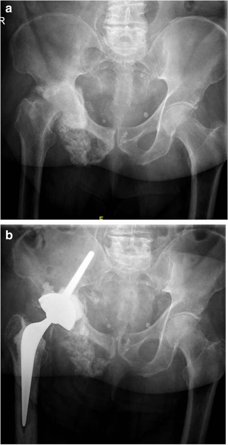 Outcomes Following Pedestal Cup Reconstruction of (Impending) Pathological Fractures of the Acetabulum due to Metastatic Bone Disease