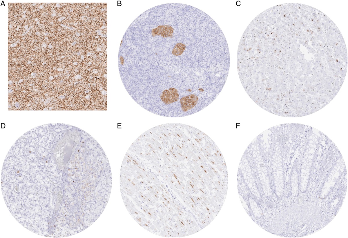 GAD2 Is a Highly Specific Marker for Neuroendocrine Neoplasms of the Pancreas