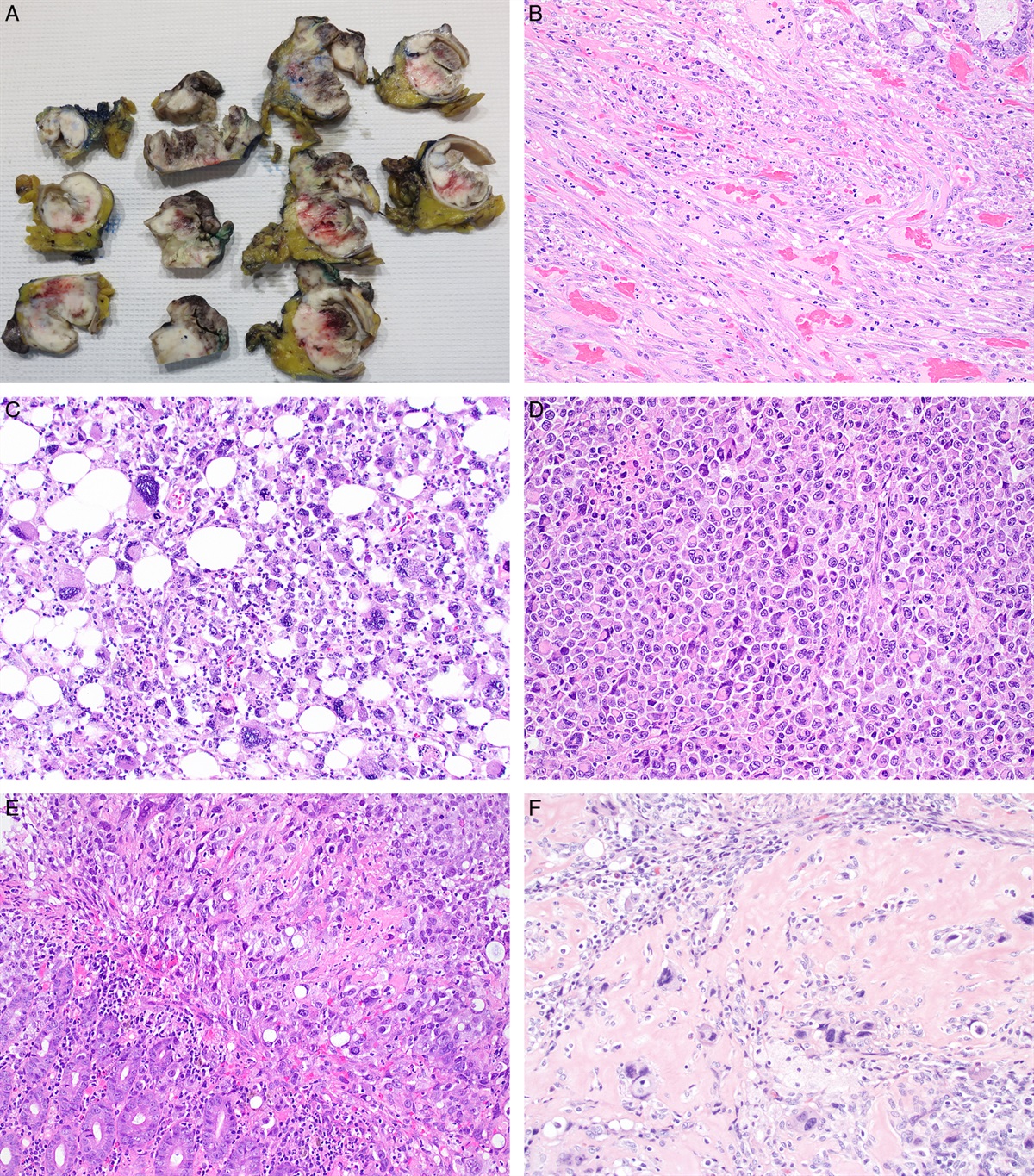 Colorectal Carcinoma With Sarcomatoid Components: Report of 15 Cases and Literature Review of an Exceedingly Rare Carcinoma Subtype