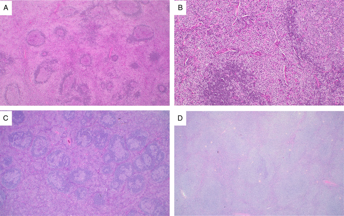 Tissue Eosinophilia in B-cell Lymphoma: An Underrecognized Phenomenon