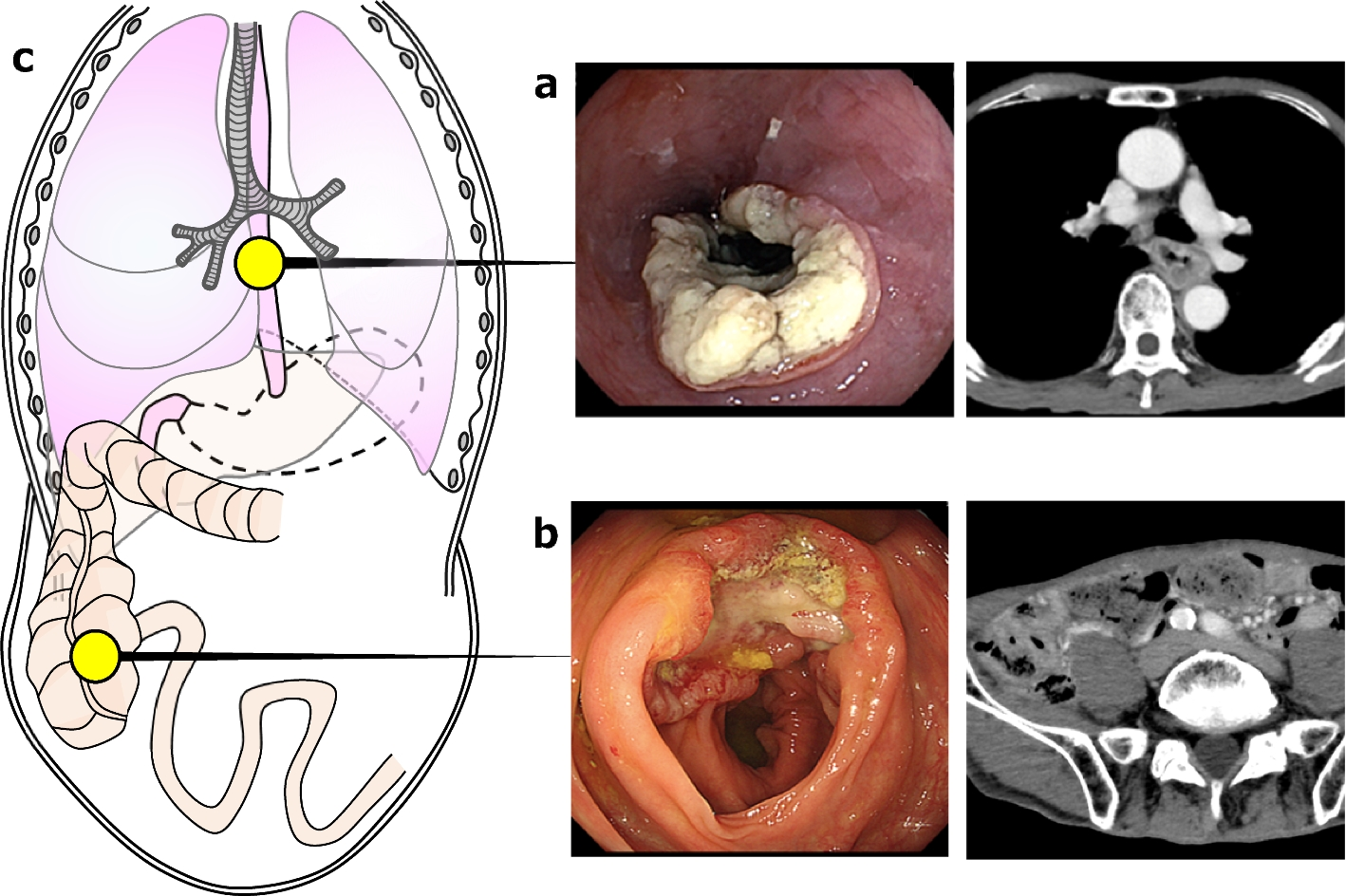 Successful multidisciplinary treatment for synchronous advanced esophageal and cecal cancers after total gastrectomy with reconstruction by jejunal interposition