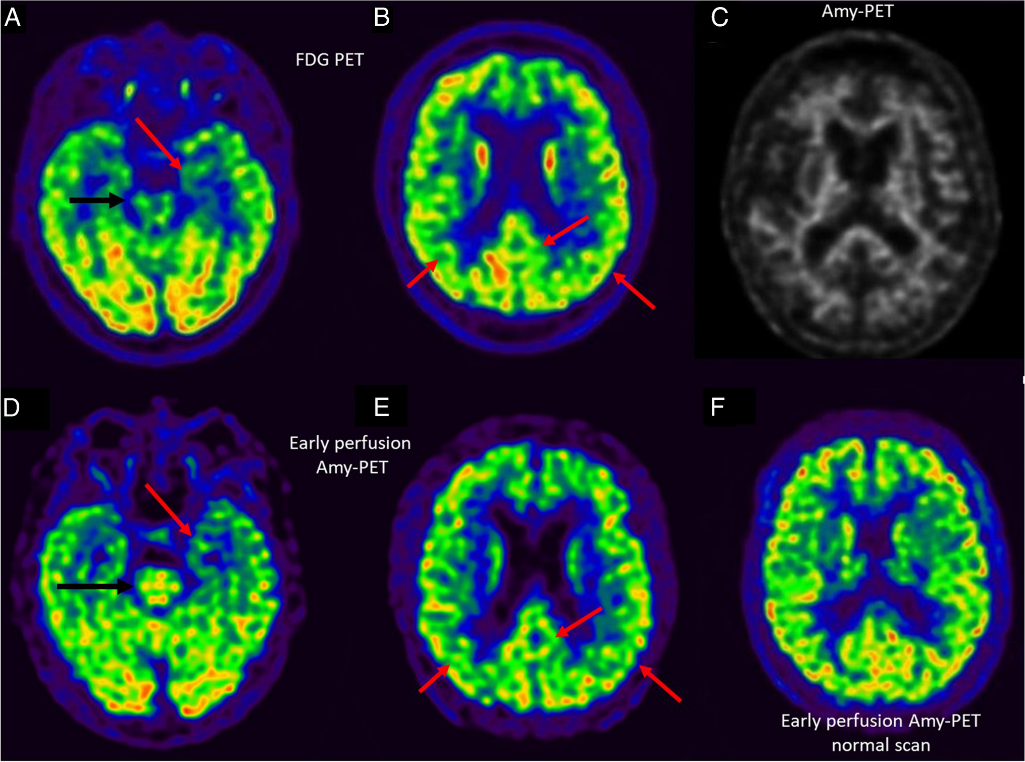 Diagnostic and prognostic value of dual-point amyloid PET in Alzheimer’s disease (AD) mimickers