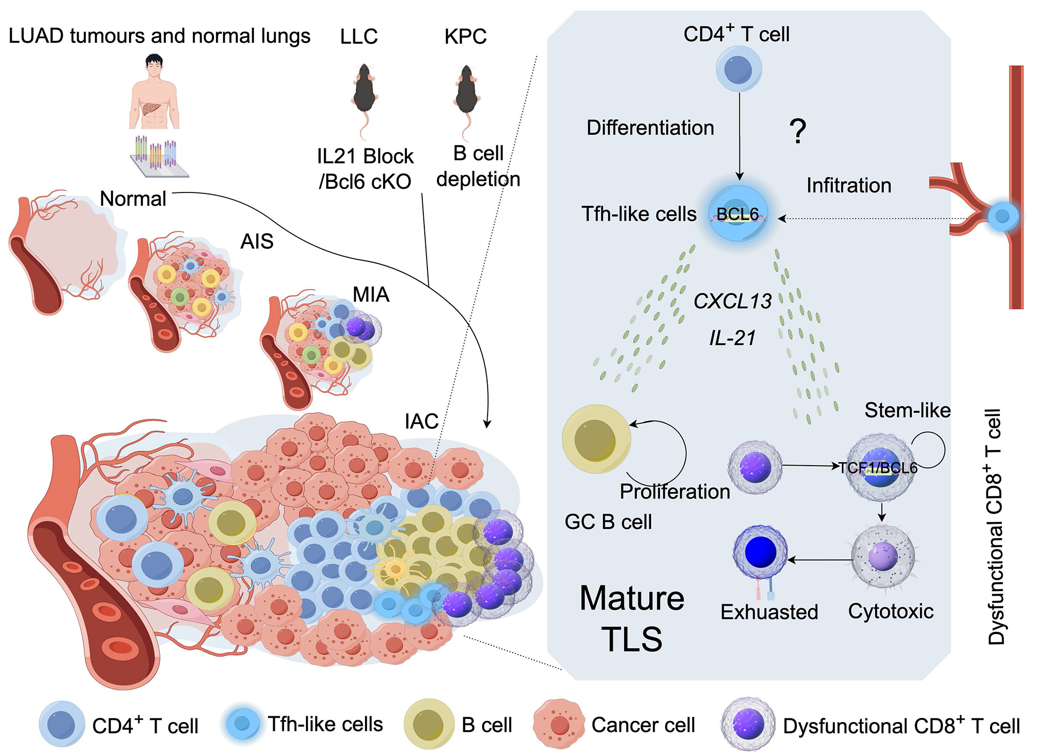 Mapping the immune terrain in lung adenocarcinoma progression: Tfh-like cells in tertiary lymphoid structures