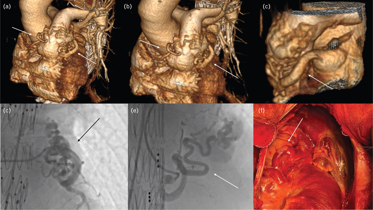 Coronary artery-to-pulmonary artery fistula: a rare congenital heart disease from cardiovascular imaging to the intraoperative findings