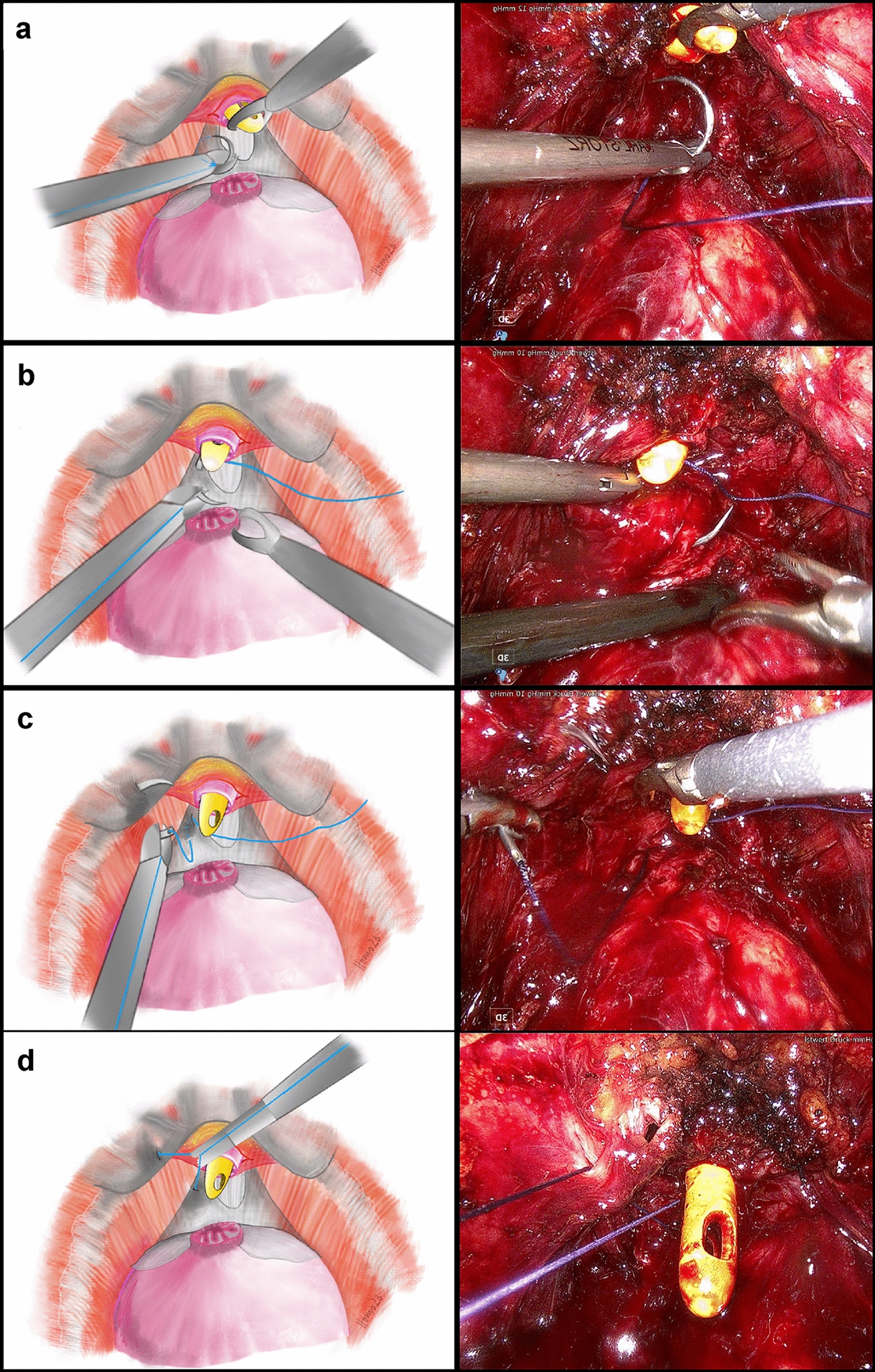 Improved early continence following laparoscopic radical prostatectomy: the urethral hammock technique